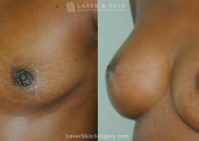 Breast Augmentation to Create Bigger Breasts
