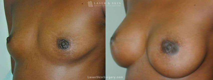 breast implants in nyc before and after