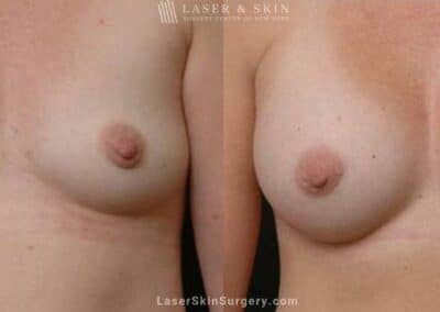 Breast Augmentation to Create Fuller Breasts