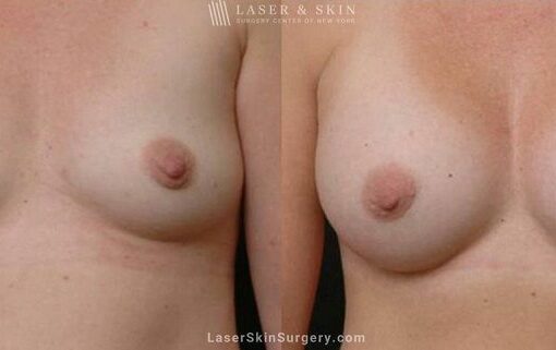 Breast Augmentation to Create Fuller Breasts