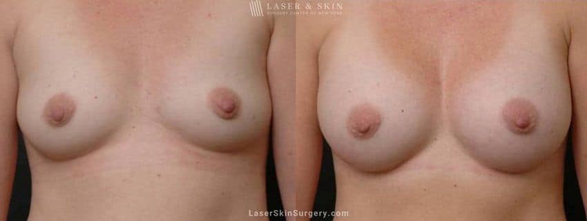 breast implants results