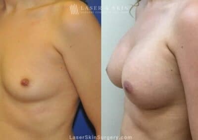 Breast Augmentation to Enhance the Breasts