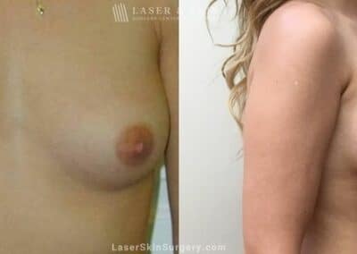 Breast Augmentation to Enlarge the Breasts