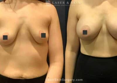 Breast Augmentation to Enhance the Breasts