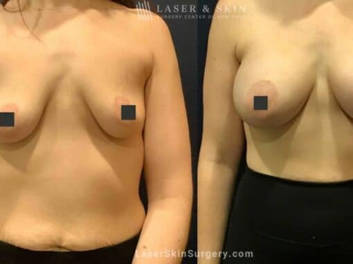 Breast Augmentation to Enhance the Breasts