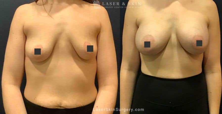 breast lift results in nyc