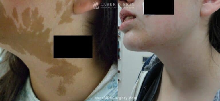 Laser treatment to reduce the appearance of Café au Lait macules