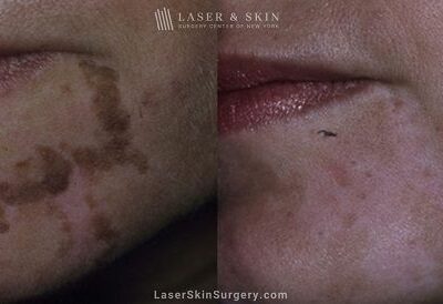 Laser Treatment for Café au Lait Macules