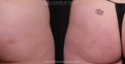 Cellfina to Reduce Cellulite