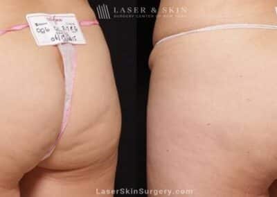 Cellfina to Treat Cellulite