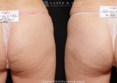 Cellulite Reduction using Cellfina