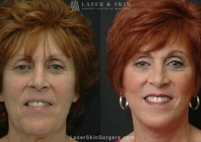 Facelift to Address Aging Symptoms