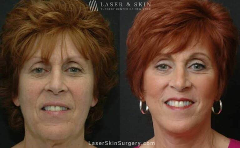 Facelift to Address Aging Symptoms