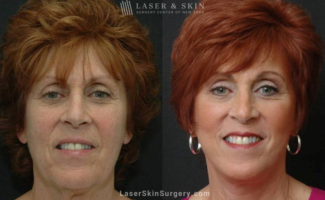 facelift on a female patient results in new york