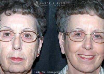 Facelift to Refresh the Appearance