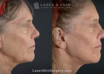 Facelift to Treat Aging Symptoms