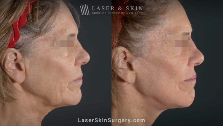 Facelift to Treat Aging Symptoms