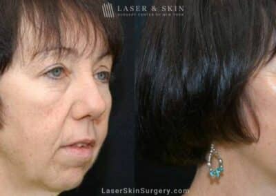 Facelift to Rejuvenate the Appearance