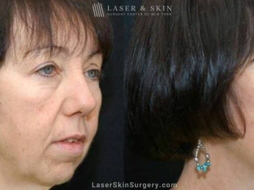 Facelift to Rejuvenate the Appearance