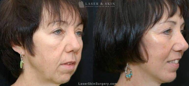 Facelift to Rejuvenate the Appearance