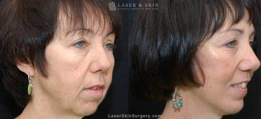 facelift before and after