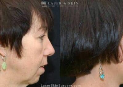 Facelift to Rejuvenate the Appearance