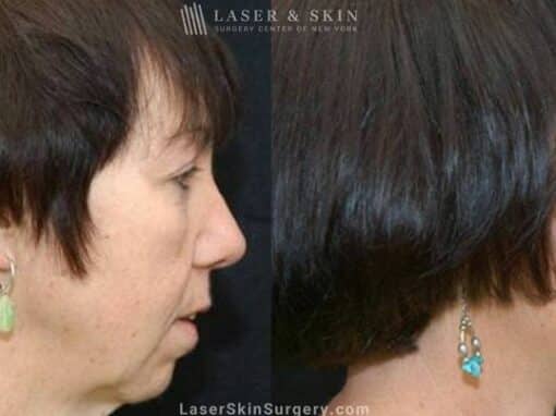 Facelift to Rejuvenate the Appearance