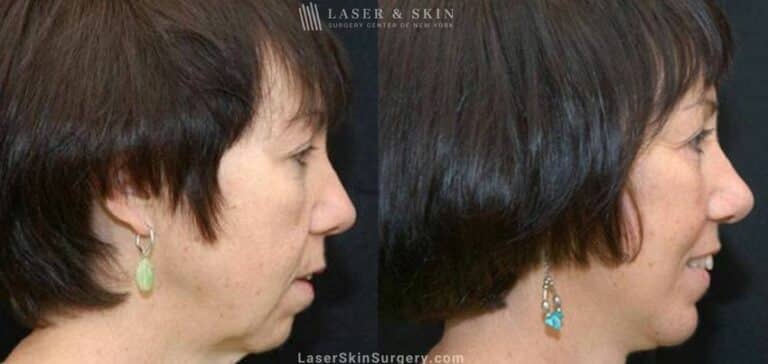 Facelift to Rejuvenate the Appearance