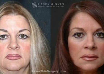 Facelift to Reverse Aging Symptoms