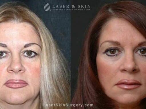 Facelift to Reverse Aging Symptoms