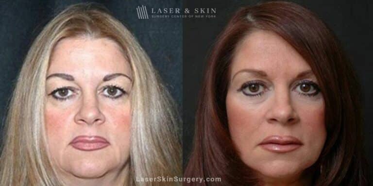 Facelift to Reverse Aging Symptoms