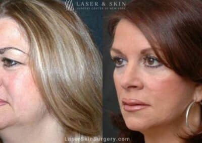 Facelift to Reverse Aging Symptoms