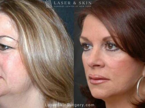 Facelift to Reverse Aging Symptoms