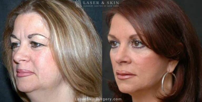 Facelift to Reverse Aging Symptoms