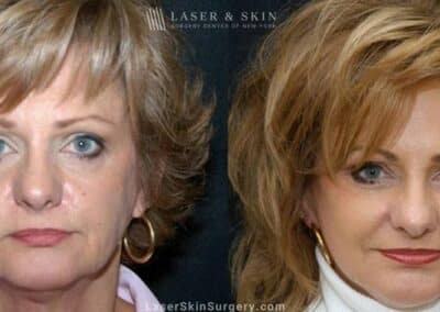 Facelift to Treat Aging in the Face