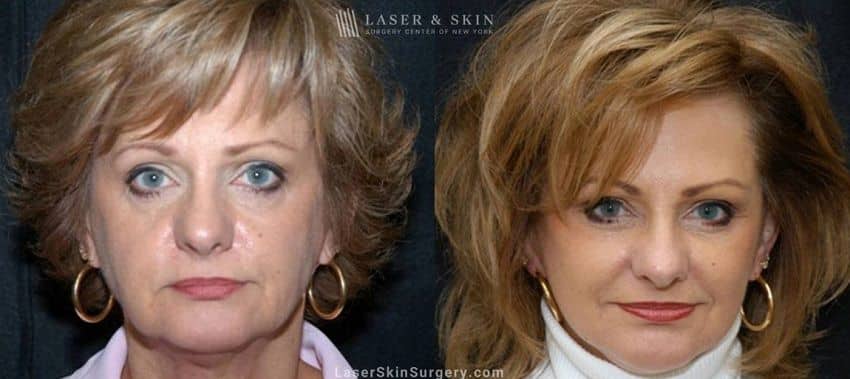 Facelift-to-treat-aging-in-the-face-New-York-City-NYC Side by Side comparison of a woman's face before and after her treatment for Sagging skin in NYC, NY. She looks more youthful with no sagging skin.