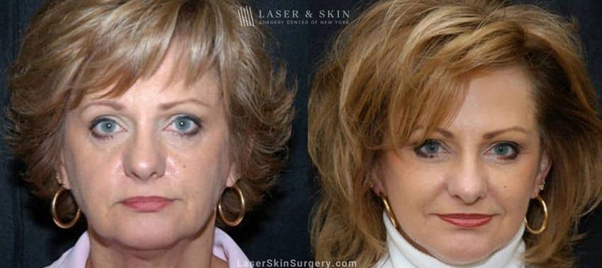 Side by Side comparison of a woman's face before and after her treatment for Sagging skin in NYC, NY. She looks more youthful with no sagging skin. 