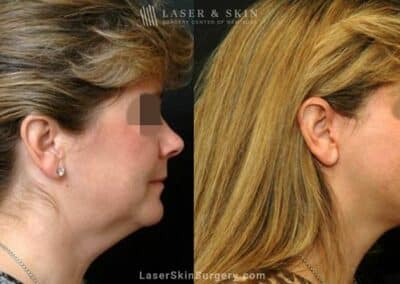 Facelift to Treat Aging Symptoms