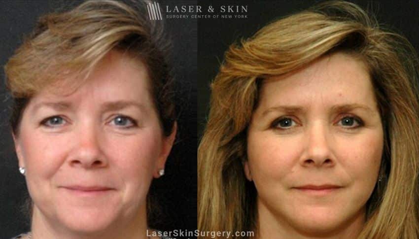 Facelift-to-treat-aging-symptoms-New-York-City-NYC-1 macs facelift before and after