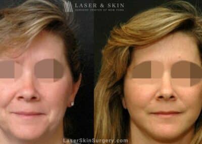 Facelift to Treat Aging Symptoms