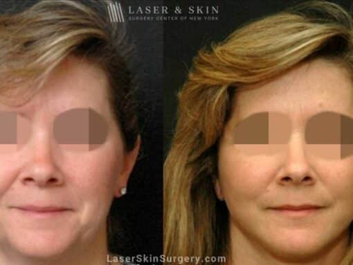 Facelift to Treat Aging Symptoms