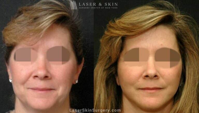 Facelift to Treat Aging Symptoms