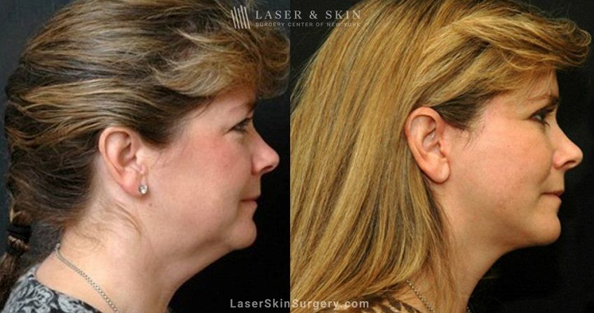 macs facelift for a female patient