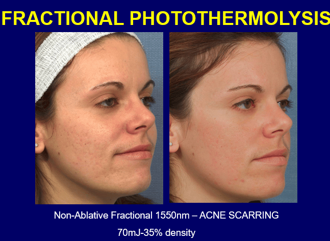 laser skin surgery center fractional photothermolysis before and after new york ny