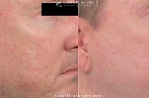 Fraxel Laser to Treat Facial Acne Scars