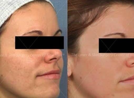 Fraxel Laser to Treat Facial Scars