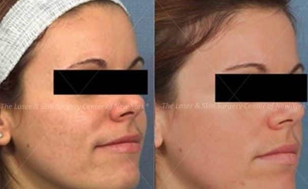 Fraxel Laser to Treat Facial Scars