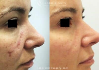 Fraxel Laser for Facial Scarring