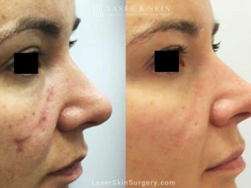 Fraxel Laser for Facial Scarring