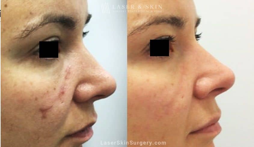 Fraxel-laser-for-facial-scars-New-York-City-NYC fraxel repair results for facial scars